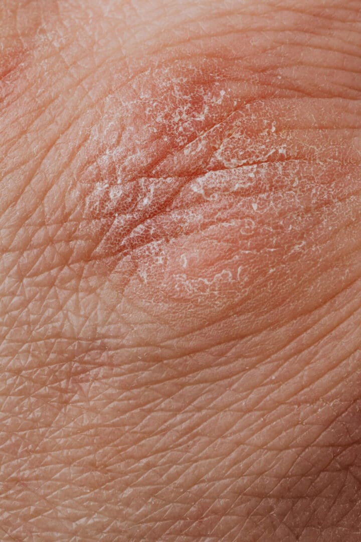 Dry, flaky skin with visible texture.